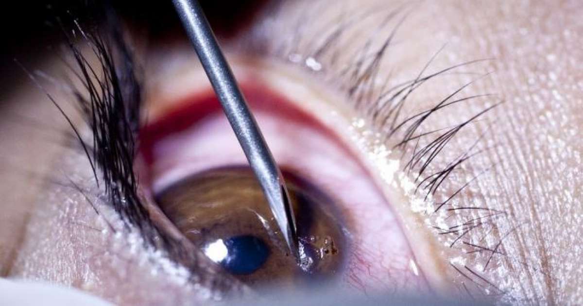 استعادت بصرها بعد سنتين: نجاح أول عملية زرع قرنية في القصرين