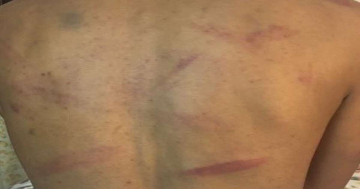 شاب تونسي يتعرض إلى التعذيب الشديد في ليبيا